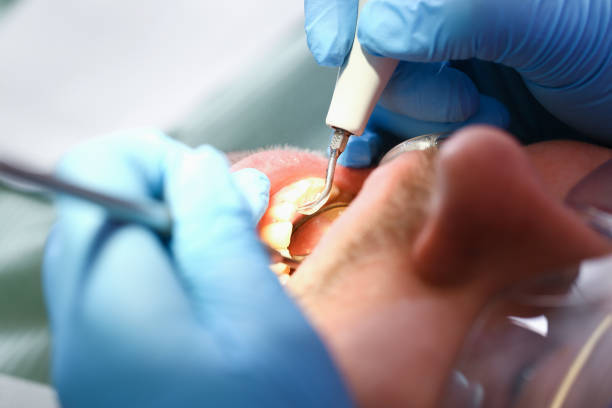 Best Emergency Tooth Extraction in Maineville, OH