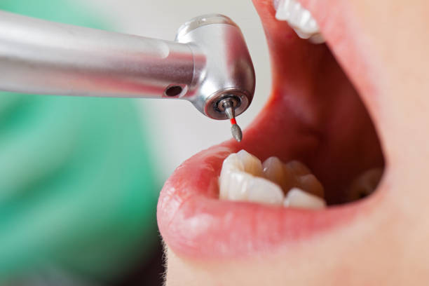 Best Emergency Dental Care for Broken or Chipped Teeth in Maineville, OH